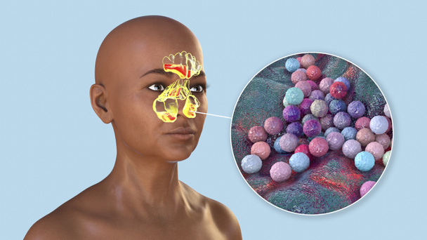 Bakterie Staphylococcus aureus, MRSA jako przyczyna zapalenia zatok. Ilustracja 3D pokazująca stan zapalny zatok czołowych i szczękowych u osoby oraz widok z bliska bakterii gronkowcowych - Zdjęcie, obraz