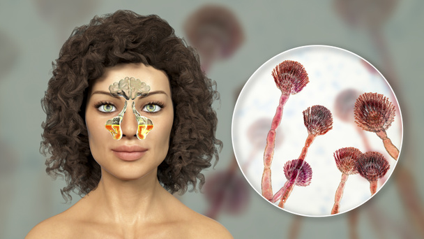 Les champignons Aspergillus sont une cause de sinusite. Illustration 3D montrant l'inflammation des sinus maxillaires chez une femme et vue rapprochée du champignon Aspergillus. Rhinosinusite fongique chronique - Photo, image