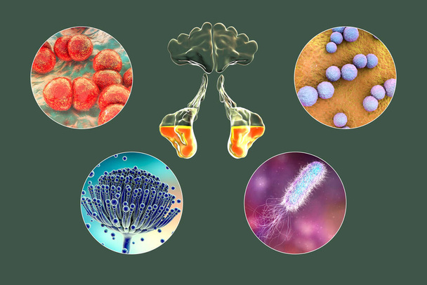 Anatomie von Rhinosinusitis und Mikroorganismen, die Sinusitis verursachen Streptococcus pneumoniae, Streptococcus mutans, Aspergillus fumigatus und Pseudomonas aeruginosa, 3D-Illustration - Foto, Bild