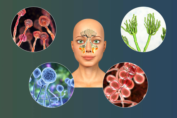 Funghi come causa di sinusite. Illustrazione 3D che mostra infiammazione dei seni mascellari e dei funghi Aspergillus, Penicillium, Mucor e Candida. Sinusite fungina cronica in pazienti immunocompromessi - Foto, immagini