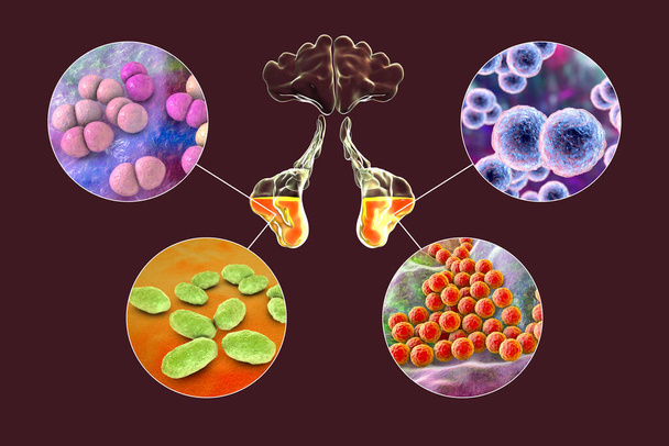 Anatomie von Rhinosinusitis und Bakterien, die Sinusitis verursachen Streptococcus pneumoniae, Moraxella catarrhalis, Haemophilus influenzae und Staphylococcus aureus, 3D-Illustration - Foto, Bild