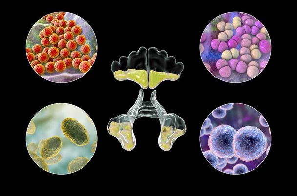 Anatomie de la rhinosinusite et des bactéries responsables de la sinusite Staphylococcus aureus, Streptococcus pneumoniae, Haemophilus influenzae et Moraxella catarrhalis, illustration 3D - Photo, image