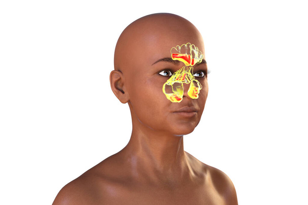 Sinusitis, inflammation of paranasal cavities. 3D illustration showing purulent inflammation of frontal and maxillary sinuses, antrum of Highmore, in a dark-skinned female person - Photo, Image