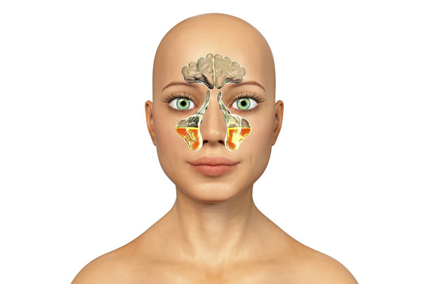 Παραρρινοκολπίτιδα, φλεγμονή των παραρρινικών κοιλοτήτων. 3D απεικόνιση που δείχνει πυώδη φλεγμονή των άνω γνάθων κόλπων, ξέσπασμα του Highmore, σε ένα θηλυκό πρόσωπο - Φωτογραφία, εικόνα