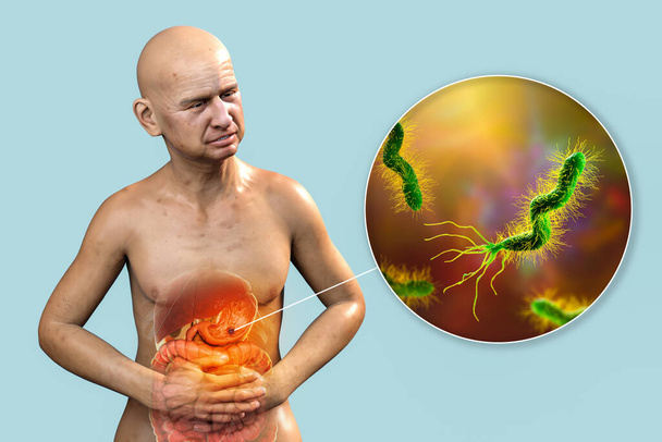 Dolor de estómago, úlcera gástrica, ilustración conceptual 3D. Paciente con estomago resaltado con úlcera y vista de cerca de bacterias Helicobacter pylori que causan desarrollo de úlcera - Foto, Imagen