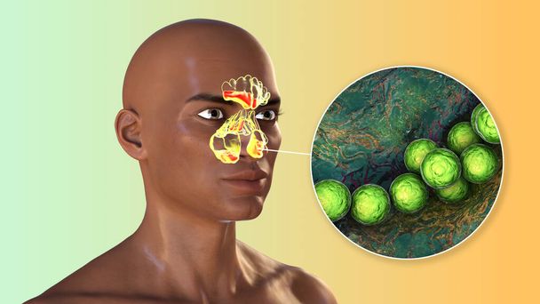 Streptococcus pyogenes bacteria and other streptococci as a cause of sinusitis. 3D illustration showing inflammation of frontal sinuses in an African man and close-up view of streptococcal bacteria - Photo, Image