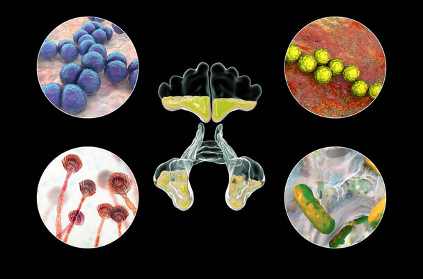 Anatomía de rinosinusitis y microorganismos que causan sinusitis bacterias Streptococcus pneumoniae, Streptococcus pyogenes, hongos Aspergillus, bacterias Pseudomonas aeruginosa, ilustración 3D - Foto, imagen