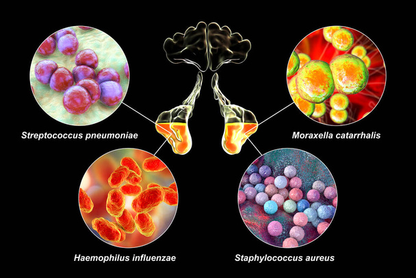 Anatomie de la rhinosinusite et des bactéries responsables de la sinusite Streptococcus pneumoniae, Moraxella catarrhalis, Haemophilus influenzae et Staphylococcus aureus, illustration marquée en 3D - Photo, image