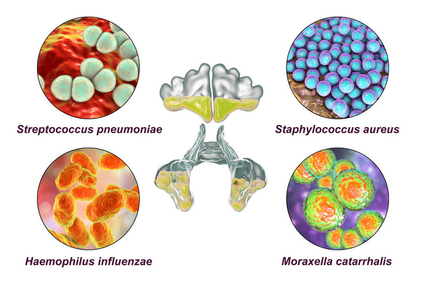 Anatomie von Rhinosinusitis und Bakterien, die Sinusitis Staphylococcus aureus, Streptococcus pneumoniae, Haemophilus influenzae und Moraxella catarrhalis verursachen, beschriftete 3D-Illustration - Foto, Bild