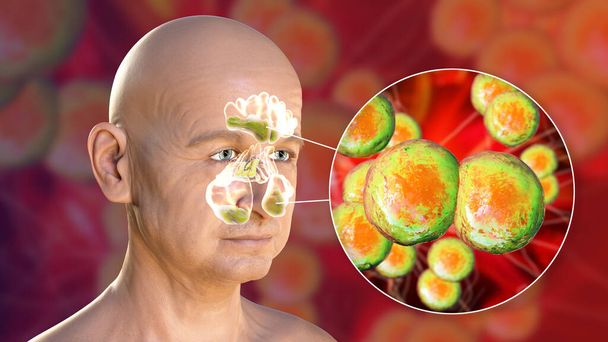 Moraxella catarrhalis Bakterien als Ursache von Sinusitis. 3D-Illustration mit eitriger Entzündung der Stirn-, Kiefer- und Nasennebenhöhlen und Nahaufnahme von Moraxella-Bakterien - Foto, Bild