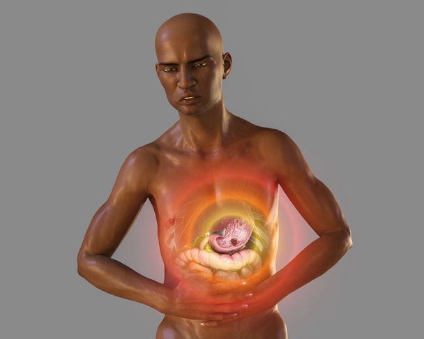 Dor no estômago, úlcera gástrica, ilustração conceitual 3D. Homem de pele escura que sofre de dor de estômago com destaque órgãos internos e úlcera no estômago - Foto, Imagem