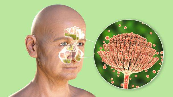 Aspergillus fungi come causa di sinusite. Illustrazione 3D che mostra infiammazione dei seni frontali, mascellari ed etmoidi in un uomo e visione ravvicinata del fungo Aspergillus. Rinosinusite fungina cronica - Foto, immagini