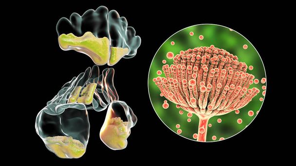 Aspergillus-Pilze als Ursache für Sinusitis. 3D-Illustration zur Entzündung der Stirn-, Kiefer- und Nasennebenhöhlen und Nahaufnahme des Aspergillus-Pilzes. Chronische Pilzdiffuse Rhinosinusitis - Foto, Bild