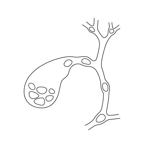 胆管および胆管内の石の位置の変種。胆石症、胆石病の模式図. - ベクター画像