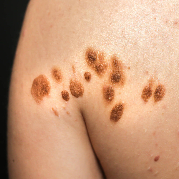 Big birthmarks and freckles on the girl's skin. Medical health photo of back. Woman's oily skin with problems acne. - Photo, Image