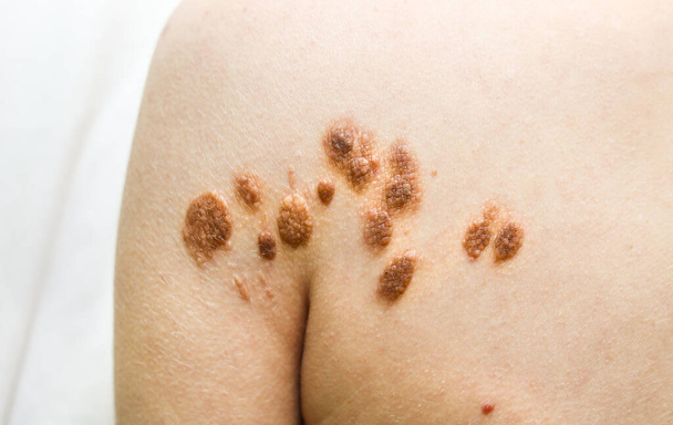Big birthmarks and freckles on the girl's skin. Medical health photo of woman's beck. - Photo, Image