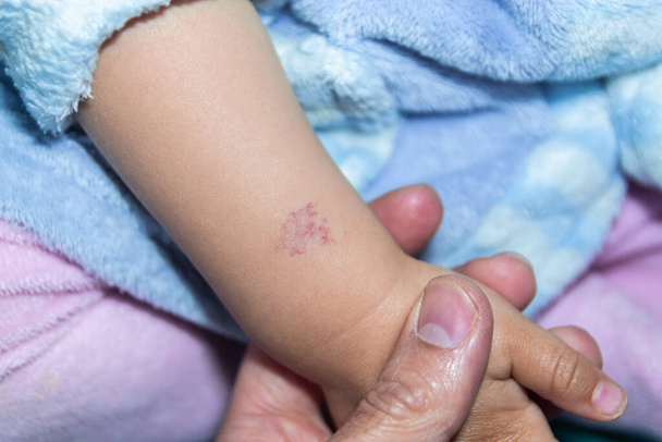Αγγείωμα ή ροζ αιμαγγείωμα στο χέρι ενός μωρού δεκαπέντε μηνών - Φωτογραφία, εικόνα