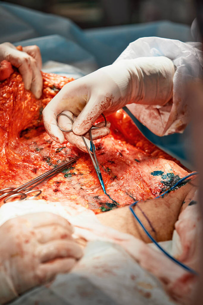 Operatie abdominoplastiek. Chirurgische verwijdering van vetweefsel uit de buik - Foto, afbeelding