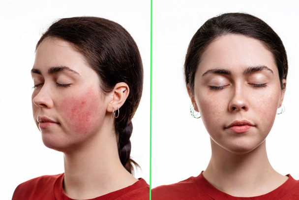 Δύο πορτρέτα μιας νεαρής καυκάσιας γυναίκας έκλεισαν τα μάτια με ροδόχρους ακμή στα μάγουλά της και χωρίς αυτήν. Το αποτέλεσμα πριν και μετά τη θεραπεία. Λευκό φόντο. Έννοια της ροδόχρου ακμής. - Φωτογραφία, εικόνα