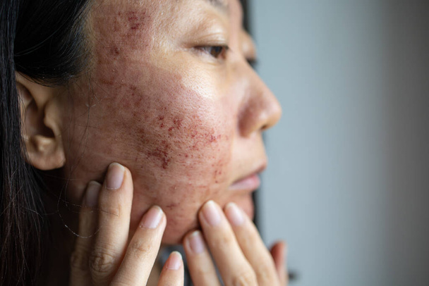 Primer plano de la piel en la cara después del tratamiento con láser. - Foto, imagen