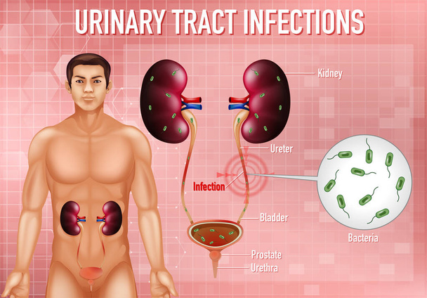 Informative illustration of urinary tract infections illustration - Vector, Image