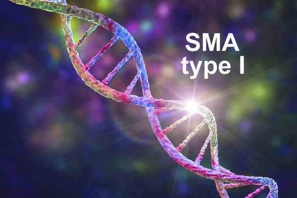Gerincmuszkuláris atrófia, SMA, 1-es típusú genetikai neuromuscularis rendellenesség progresszív izomsorvadással a motoros neuronok SMN1 génmutáció miatti elvesztése miatt, fogalmi 3D illusztráció - Fotó, kép