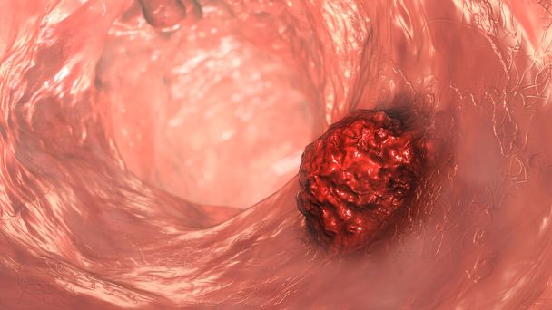 Cáncer colorrectal, carcinoma intestinal, neoplasia intestinal, ilustración 3D que muestra tumor maligno en el intestino - Foto, Imagen
