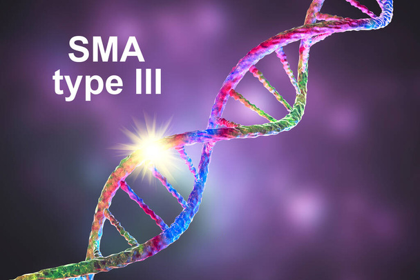 Spinale spieratrofie, SMA, type 3, een genetische neuromusculaire aandoening met progressieve spierverspilling als gevolg van verlies van motorische neuronen als gevolg van mutatie in het SMN1 gen, conceptuele 3D illustratie - Foto, afbeelding