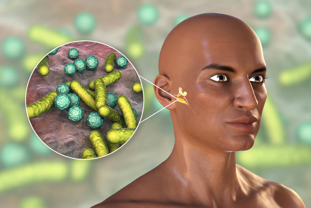 Välikorvatulehdus, välikorvan tulehdussairaus, 3D-kuva afrikkalaisesta miehestä, jolla on koholla olevat keski-ilman rakenteet, joissa on märkää ja välikorvatulehdusta aiheuttavia bakteereja - Valokuva, kuva