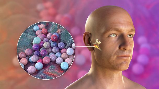 Стафілококова ауреусова бактерія як причина ототиту. 3D ілюстрація, що показує гнійне запалення середнього вуха у чоловічої особи та крупним планом бактерії стафілококів
 - Фото, зображення