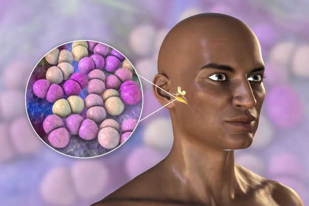 Streptococcus pneumoniae Bakterien als Ursache von Sinusitis. 3D-Illustration zeigt eitrige Entzündung der Stirnhöhlen bei einem Afrikaner und Nahaufnahme von Pneumokokken-Bakterien - Foto, Bild