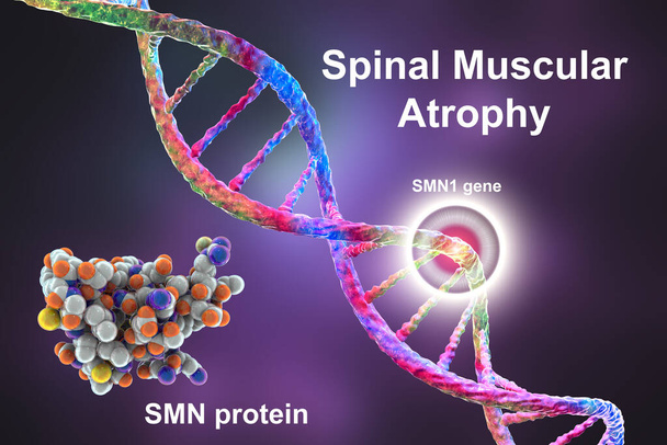 Κοιλιακή μυϊκή ατροφία, SMA, μια γενετική νευρομυϊκή διαταραχή με προοδευτική απώλεια μυών λόγω απώλειας κινητικών νευρώνων λόγω μετάλλαξης στο γονίδιο SMN1, εννοιολογική τρισδιάστατη απεικόνιση - Φωτογραφία, εικόνα