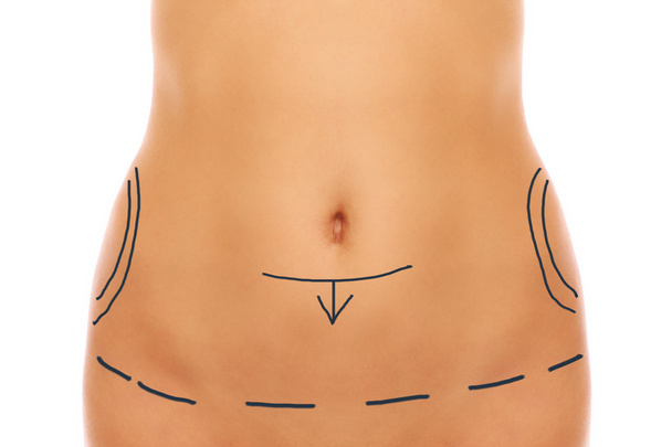 Cirugía del vientre
 - Foto, imagen