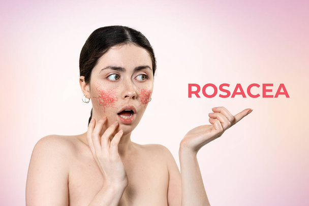 Concept van behandeling van couperose. Portret van een jonge bange vrouw met roodheid op haar wangen. Roze verloop achtergrond. Tekst rosacea. - Foto, afbeelding