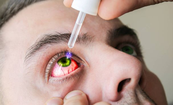 Az ember cseppeket ad a szemébe. Orvosi kezelési koncepció. Allergiás kötőhártya-gyulladás. - Fotó, kép