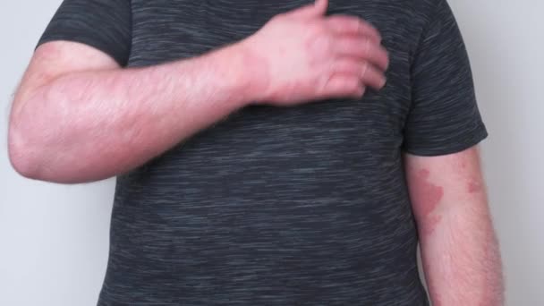 A fickó megvakarja a kezét borított pikkelysömör, ami nagyon viszket, a koncepció a pikkelysömör, ekcéma és más betegségek száraz bőr - Felvétel, videó