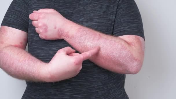 The guy scratches his hands covered with psoriasis, which itch very much, the concept of psoriasis, eczema and other diseases of dry skin - Footage, Video