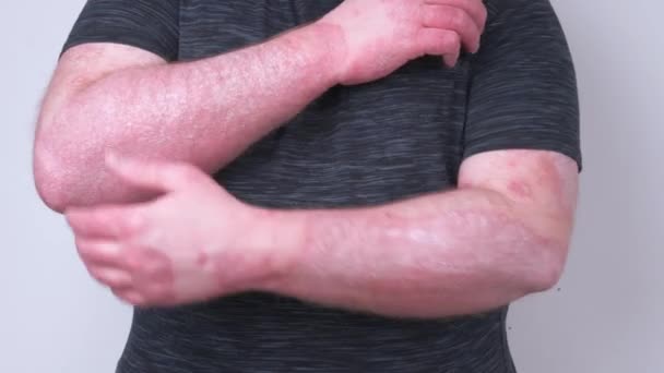 Ten chlap poškrábe ruce pokryté lupénkou, která svědí velmi silně a jeho klouby bolí, koncept lupénky, ekzém a další nemoci suché kůže - Záběry, video
