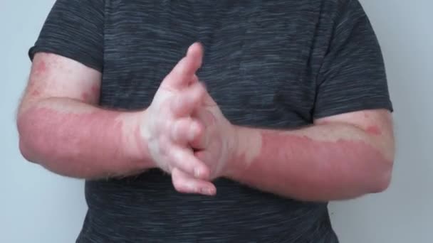 A guy smears his hands with ointment, his hands covered with psoriasis, which itch very much, the concept of psoriasis, eczema and other diseases of dry skin - Footage, Video