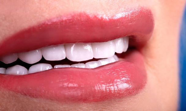 Perfect Close Up White beautiful Veneers Λεύκανση δοντιών κορώνες λεύκανση νεαρή κοπέλα χαμογελώντας, αισθησιακό θηλυκό παχουλό χείλη γυναίκα χαμόγελο. Χειρουργική αποκατάσταση εμφυτευμάτων οδοντικών ζιρκονίων. Έννοια μόδας - Φωτογραφία, εικόνα
