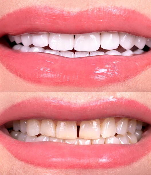 Perfektes Lächeln vor und nach Veneers Bleiche von Zirkon Bogen Keramik Prothese Implantate Kronen. Zahnrestaurationsbehandlung Klinik Patient. Ergebnis der oralen Chirurgie Zahnaufhellung - Foto, Bild