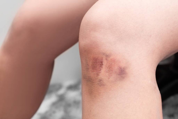 Selectieve focus van blauwe plekken en schaafwonden op de knie van de vrouw. Ongelukken en gezondheidszorg concept. Pijn van de val  - Foto, afbeelding