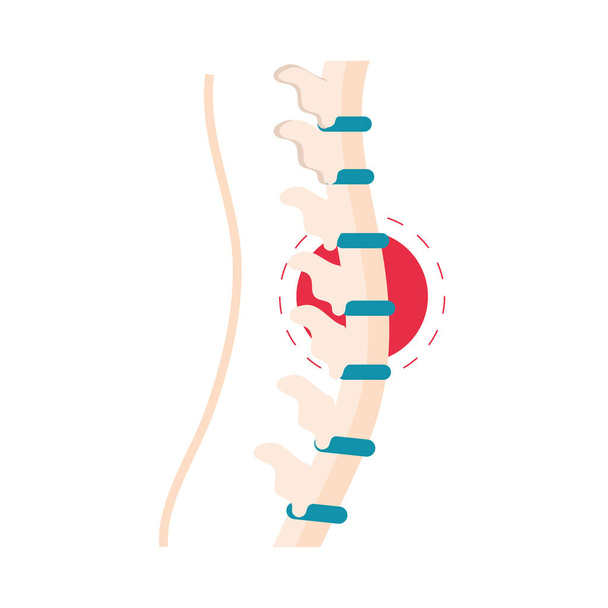 columna vertebral de reumatismo - Vector, imagen