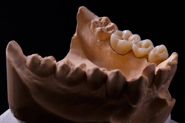 Hampaiden hometta. Kipsi malli kipsi hampaita. Kipsi valettu hampaita ihmisen valmisteltaessa tuottaa hampaiden kruunu. Stomatologinen kipsi valettu, muotit ihmisen leuat ja hampaat mustalla pohjalla. Hammaslääketieteen ja oikomishoidon käsite. - Valokuva, kuva