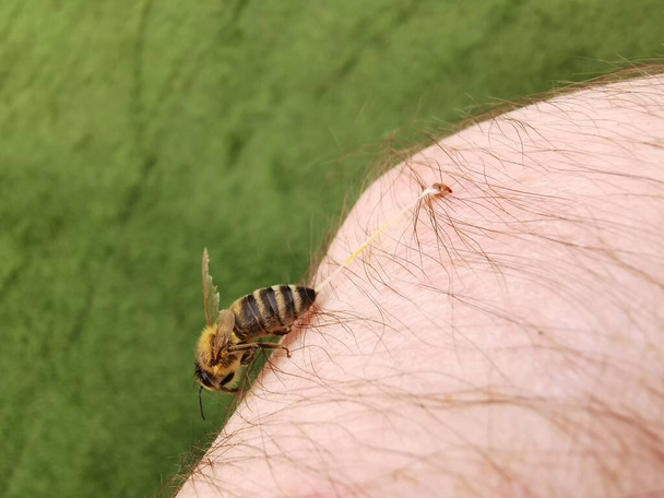 ošetření včelím bodnutím. apitherapy - Fotografie, Obrázek