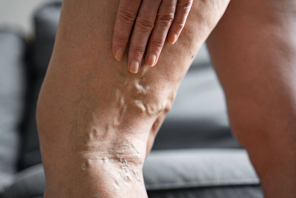 Varicose vein close up leg. Senior woman health problem. Foot with Diseased Veins. Health Care, Podiatry. - Фото, зображення