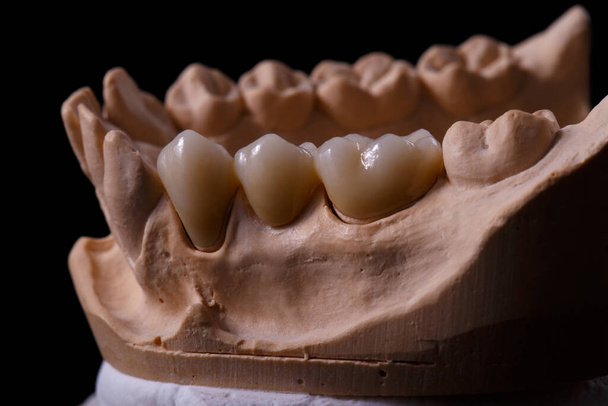 Μια φοράδα δοντιών. Gypsum πρότυπο γύψο των δοντιών. Στοματολογικό γύψο, καλούπια από ανθρώπινα σαγόνια και δόντια σε μαύρο φόντο. Οδοντιατρική και ορθοδοντική έννοια. - Φωτογραφία, εικόνα