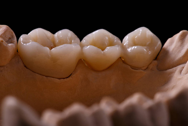 Μια φοράδα δοντιών. Gypsum πρότυπο γύψο των δοντιών. Γυψοσανίδες δοντιών από άνθρωπο σε προετοιμασία για την παραγωγή οδοντικού στέμματος. Οδοντιατρική και ορθοδοντική έννοια. - Φωτογραφία, εικόνα