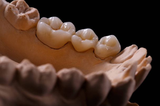 Forma zębów. Tynk gipsowy z zębami. Gips stomatologiczny, formy ludzkich szczęk i zębów na czarnym tle. Koncepcja stomatologii i ortodoncji. - Zdjęcie, obraz