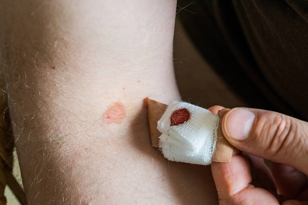 Merkki ja mustelma veren keräämisen jälkeen, henkilö, joka repii laastarin irti hoitajalta neulan pistoskohdan sidoksella, - Valokuva, kuva